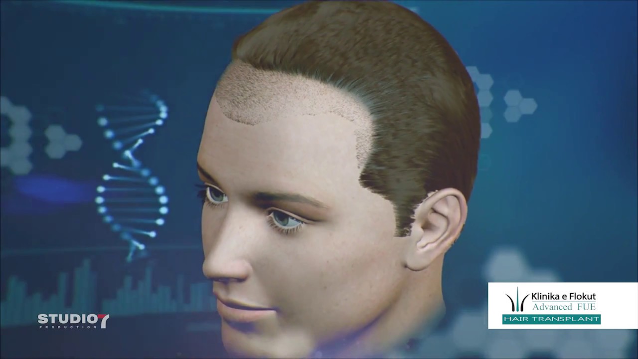 Mbjellje Floku me metoden e avancuar FUE ne Kosove,Shqiperi dhe Maqedoni