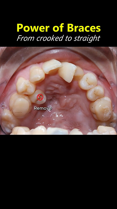 Amazing braces. From crooked teeth to straight #braces #orthodontist #dentist #teeth