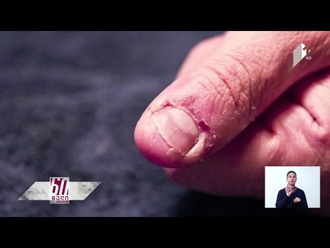 მავნე ჩვევები - რა კავშირშია დერმატოფაგია შფოთვითი აშლილობის სინდრომთან