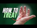 Dupuytren's Contracture (Starts as Lump on Hand) How to Treat
