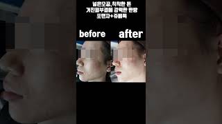 포텐자 쥬베룩 모공 잔주름 시술