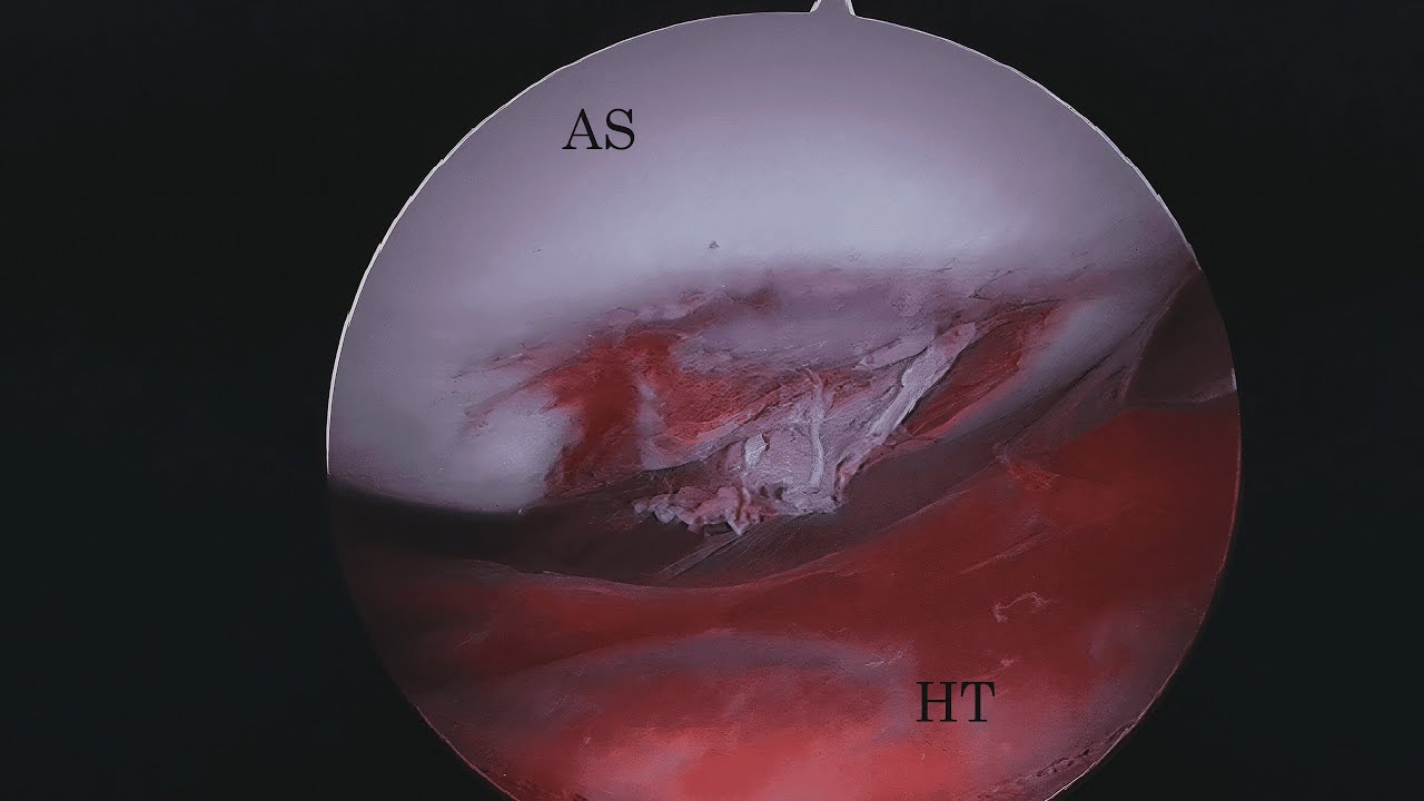 hemorrhagingtissue, офелия. - Sanguinis astra (Audio)
