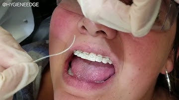 Super Floss-Why you need it