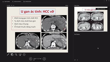 CDHA- Cấp cứu bụng không do chấn thương