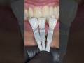 Checking the Color - Part 2 #chairsideshadeguide #lukekahngshadeguide #dental #teeth #lsk121shorts