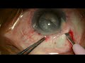Surgery manual small incision cataract surgery using blumenthal technique