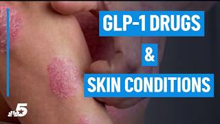 GLP-1 drugs could have impact on dermatology | NBC DFW