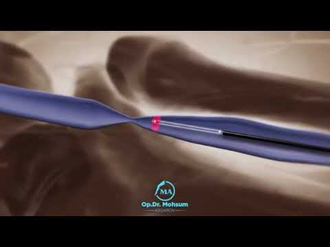 Video: Varikoz damarlarından qurtulmağın 12 yolu