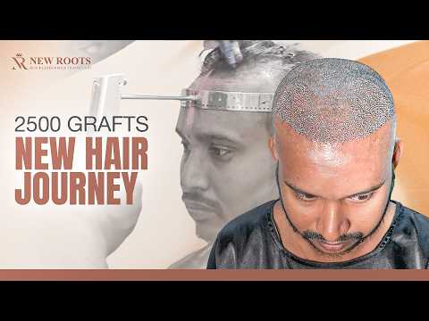 Hair Surgery Was Easier Than I Expected 😃 | Hair Transplant in Raipur | New Roots | Hindi