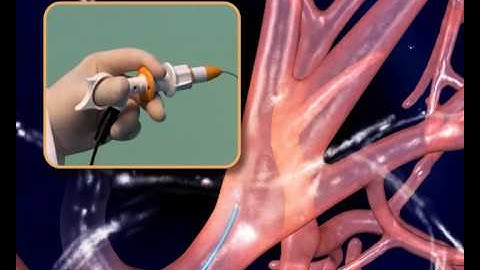 SuperDimension inReach System