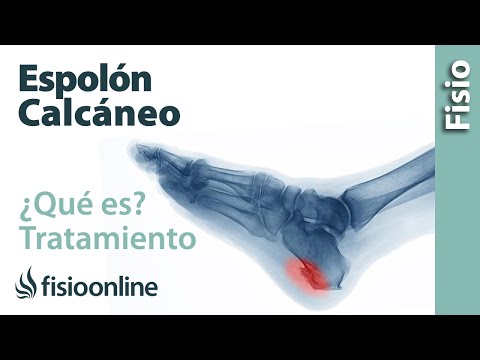 Vídeo: Espolón óseo En La Parte Superior Del Pie: Causas, Tratamiento Y Prevención