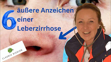 Wie merkt man den Beginn einer Leberzirrhose?