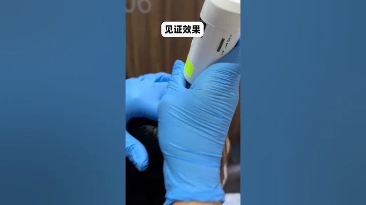 頭皮屑多到一撓頭皮，就像下雪❄🙈頭髮還特別容易出油和瘙癢...😥使用各種去頭皮屑的產品都是治標不治本🤑🤷‍♀該如何是好呢?🤨😖 - 天天要聞