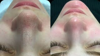 Clean Girl Skin: fresh, clear, smooth, poreless, zero imperfections  screenshot 2