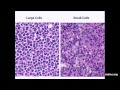 What You Need to Know about Non-Hodgkin's Lymphoma: Presentation