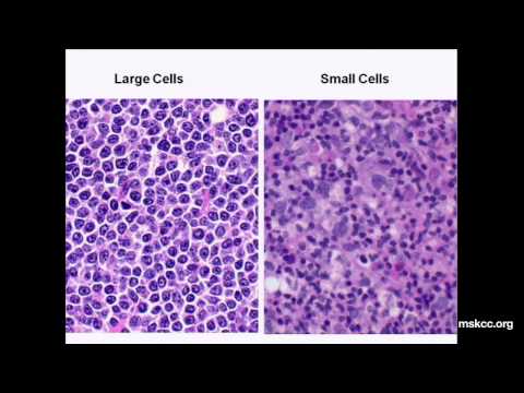 What You Need to Know about Non-Hodgkin's Lymphoma: Presentation Hqdefault