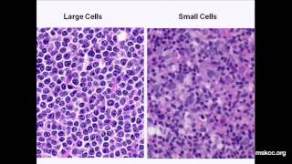 What You Need to Know about Non-Hodgkin