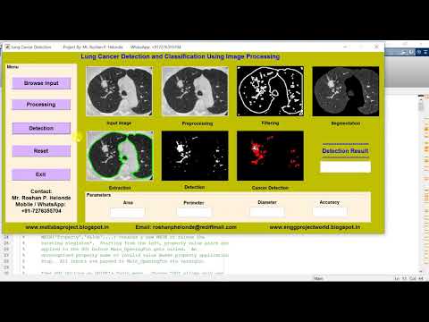 Lung Nodule Detection | Project With Source Code | Final Year Projects