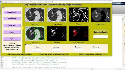 Lung Nodule Detection | Project With Source Code | Final Year Projects