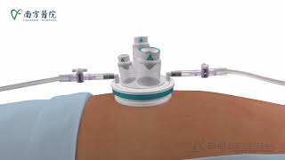 Single-incision Laparoscopic Surgery Single-Port
