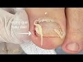 A PELE SIMPLESMENTE DESCOLA 😱 Remoção real de peeling químico. #satisfying #nails #usa