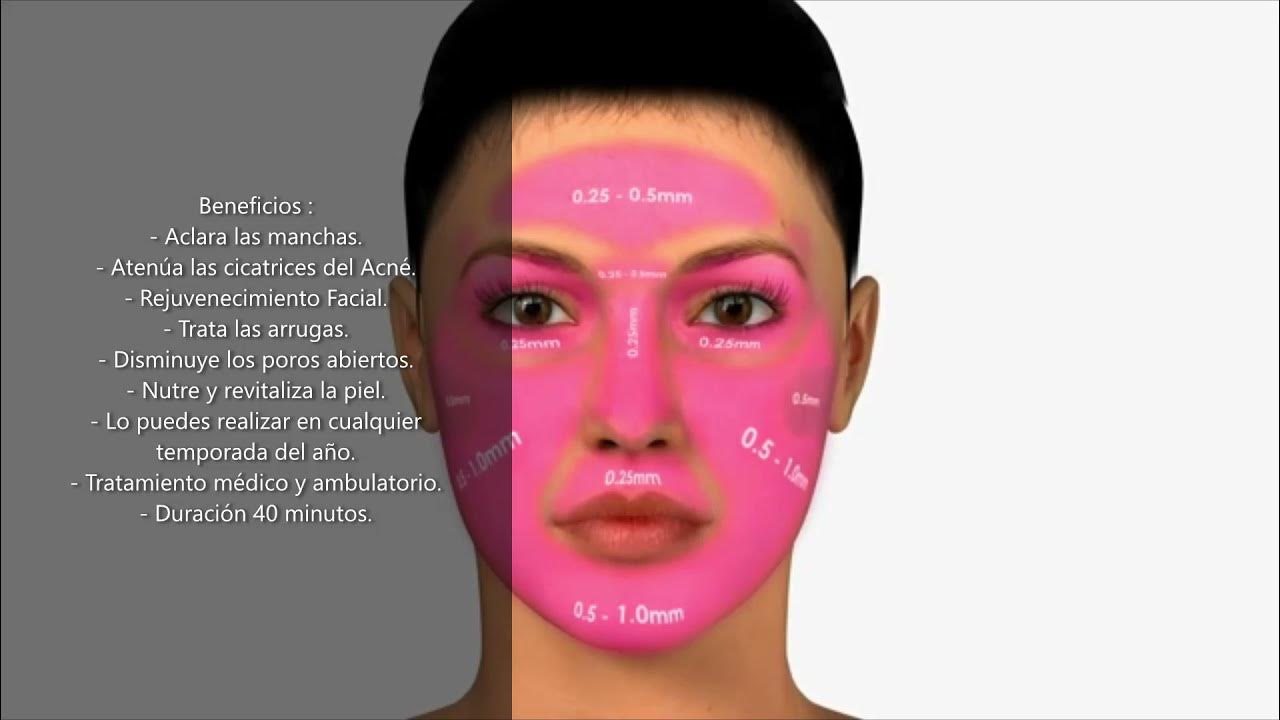 Tratamiento de Dermapen. YouTube