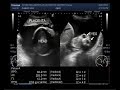 Ultrasound Video showing twin pregnancy with one  anencephalic fetus and polyhydromnios.