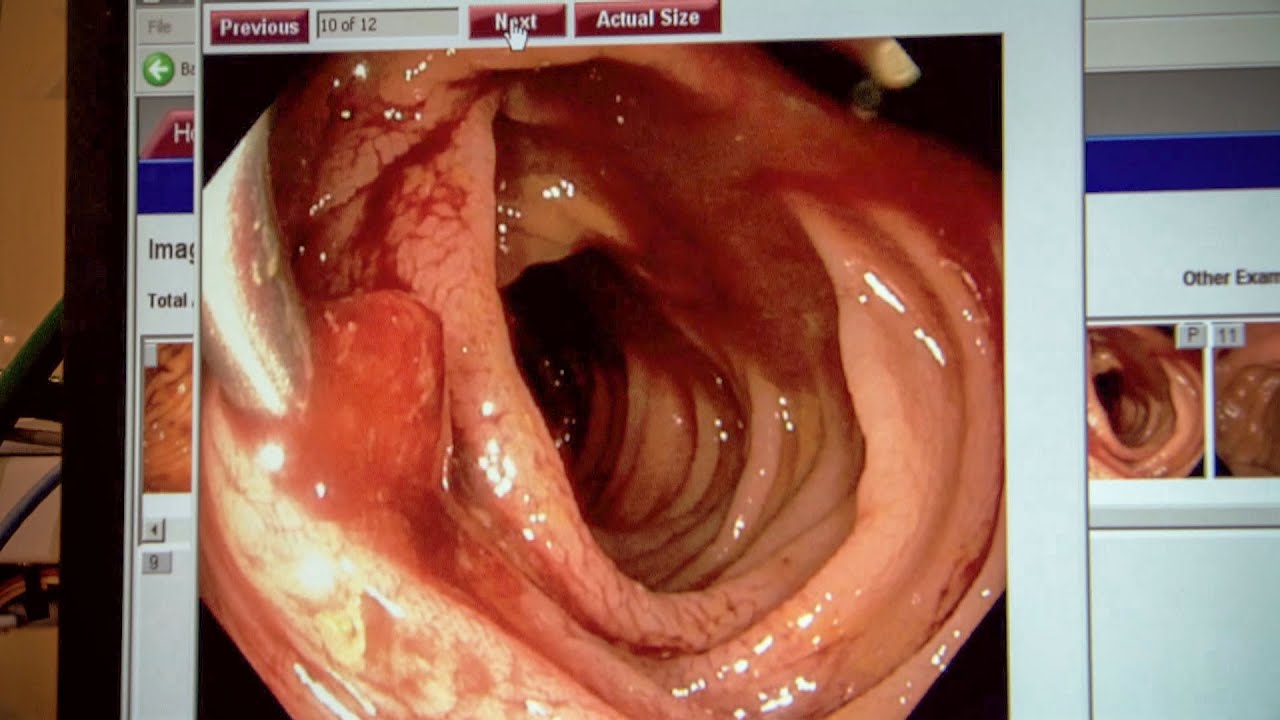 USPSTF Recommendation Statement: Screening for Colorectal Cancer