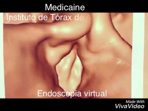 Estenose Traqueal