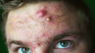 EVERY ACNE SUFFERER NEEDS TO SEE THIS | How To Get Past the Insecurity!