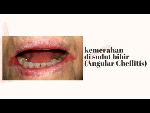 Video: 10 Penyebab Sudut Mulut Pecah-pecah