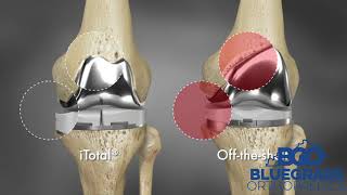 Dr. Wallace Huff - Custom 3D Conformis Knee Replacement