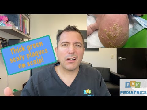 Vídeo: Cradle Cap En Adultos: Tratamiento, Causas, Recomendaciones De Productos