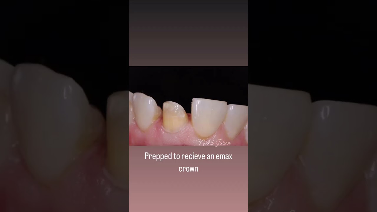 Experience Painless Root Canal at 