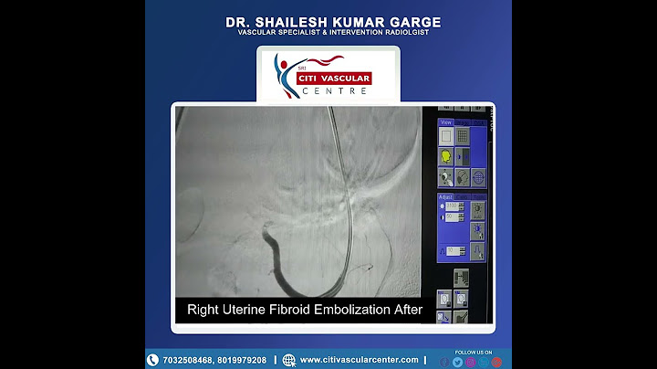 LIVE UTERINE FIBROID EMBOLIZATION I Before & After I Treatment