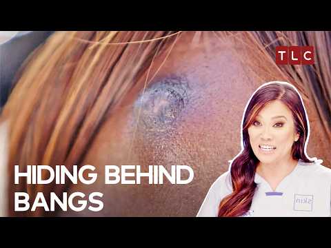Large Cysts Popped