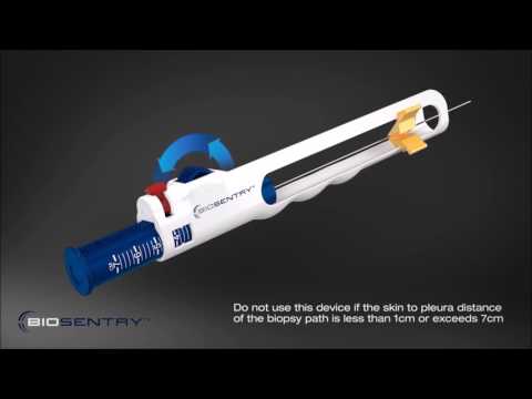 BioSentry™ tract sealant system