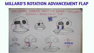 Unilateral cleft lip repair-millard's rotation-advancement flap