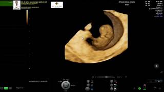 Embryo Normal 8-9 Weeks (Dr Wiku Andonotopo)