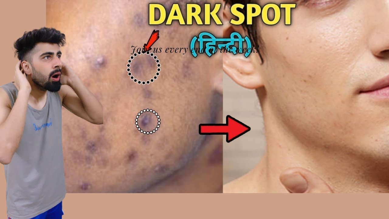 How To Remove DARK SPOTS From Face Naturally Mridul Madhok YouTube how-to-remove-dark-spots-from-face-naturally-mridul-madhok-youtube