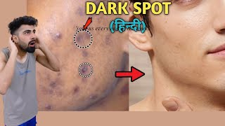 How To Remove DARK SPOTS From Face Naturally | Mridul Madhok