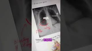 PLEURAL EFFUSION #hospital #doctorinmaking #mbbs