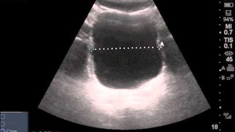 Ultrasound Estimated Post-Void Residual Bladder