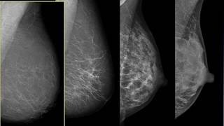 Breast Cancer Screening - The Basics for Nevada