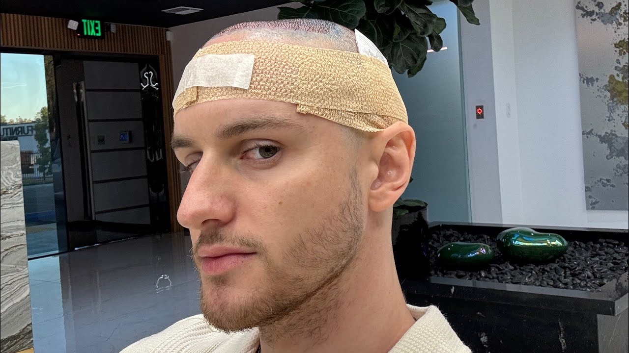 Hair transplant everything you need to know!