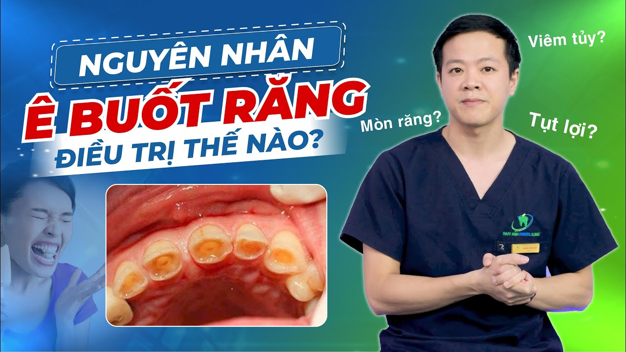 Outline Video CÁCH CHỮA Ê BUỐT RĂNG - CÓ THỂ ÁP DỤNG NGAY TẠI NHÀ