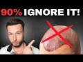 6 warning signs hair transplant is not for you