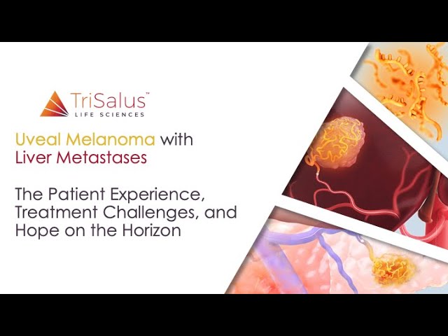 Uveal Melanoma with Liver Metastases: Patient Experience, Treatment Challenges & Hope on the Horizon