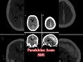 Stroke #neurosurgery #science #surgery #neurology #radiology #doctor #intervention #medicine