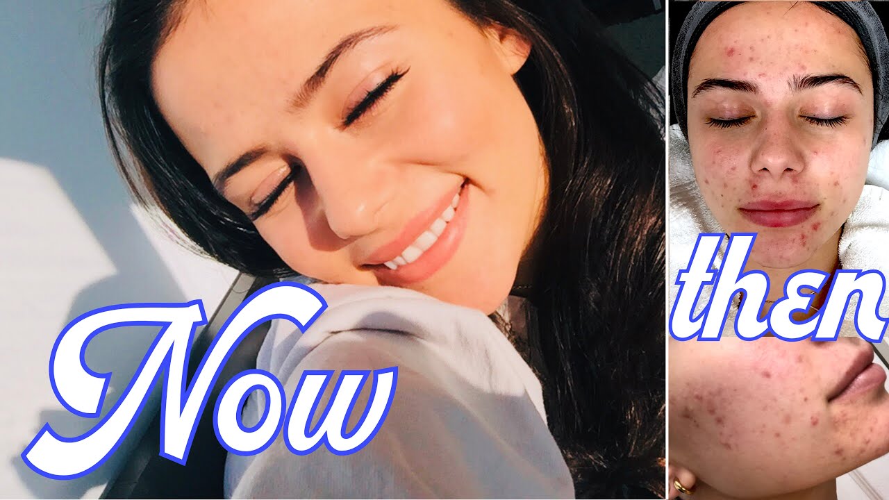 HOW I FINALLY GOT RID OF MY ACNE | From Natural to Accutane (3 Month ...
